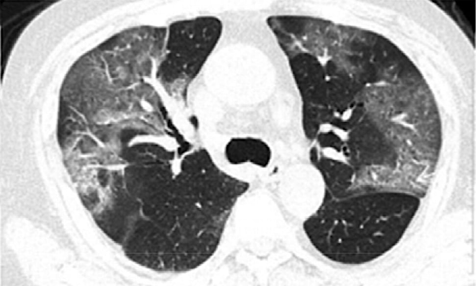 来自放射学文章的新型冠状病毒2019-nCoV CT图像显示一名75岁男性的基线CT图像，多发性斑片状纯磨玻璃不透明区(GGO)和GGO伴网状和/或小叶间隔增厚。入院后第3天的随访CT图像显示，组织性肺炎与弥漫性肺泡损伤重叠，弥漫性更强，与底层网状有关。阅读更多内容，在文章中查看15张来自新型冠状病毒患者的图片。