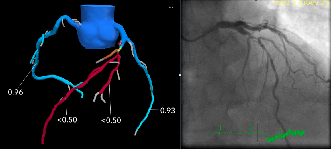 一个FFR-CT成像的例子来自密歇根州皇家橡树的博蒙特医院。左图显示的是CT扫描生成的冠状动脉树的3D图像，通过计算流体动力学评估以确定FFR值。显示左主动脉严重受限需要支架进行再真空。右边的图像是与支架置入前导管实验室的侵入性血管造影术的对比。