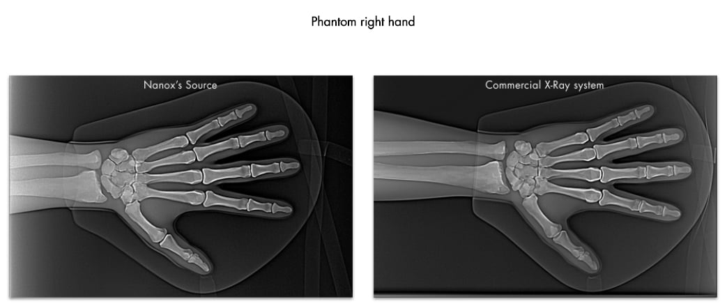Nanox冷阴极射线与标准x射线管图像进行比较