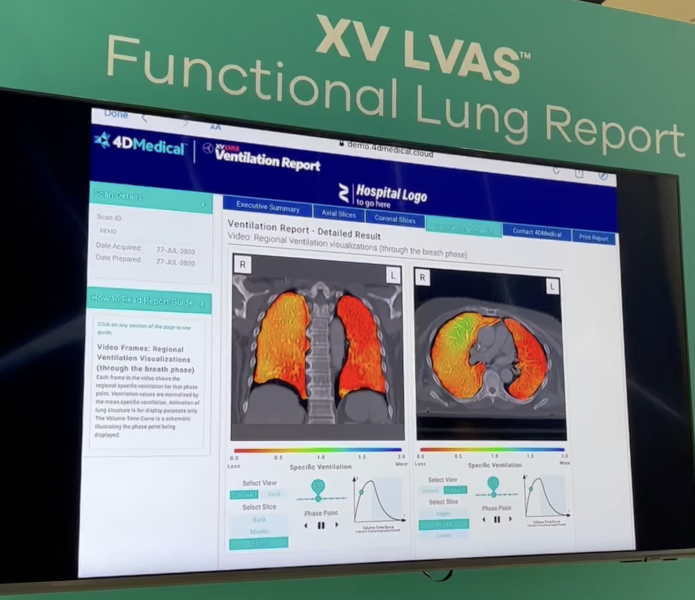 4D Medical在RSNA 2022期间展示的XV LVAS数字通气报告包括放射科医生可以用来为他们的推荐临床医生提供可操作的见解的数据。数据包括通风缺陷百分比(VDP)、潮气量和通风异质性。根据LVAS数学分析，彩色编码的肺部图像显示高通气区域(红色)、正常通气区域(绿色)和过度通气区域(蓝色)。