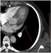 在常规CT图像上疑似肺栓塞，在频谱CT上发现相应的楔形灌注缺损。