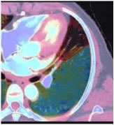 在常规CT图像上疑似肺栓塞，在频谱CT上发现相应的楔形灌注缺损。