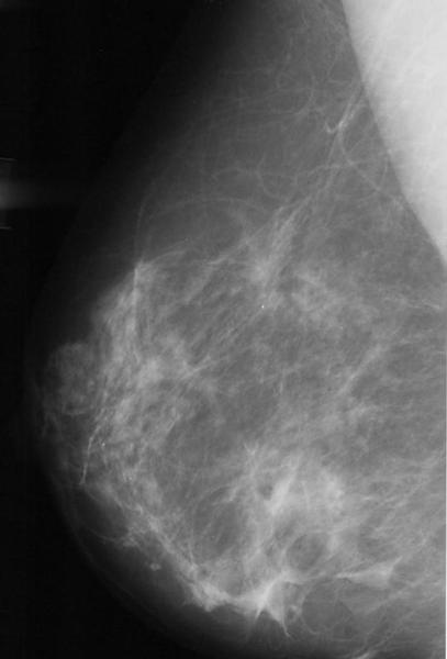 图9。正常的乳房x光检查。