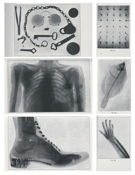 x射线使用的早期历史例子