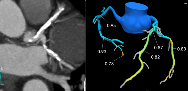 左边的冠状动脉CT检查显示了由于钙化斑块造成的严重冠状动脉阻塞。然而，右侧FFR- ct图像显示FFR分析，不需要支架。影像由密歇根州皇家橡树的博蒙特医院提供。