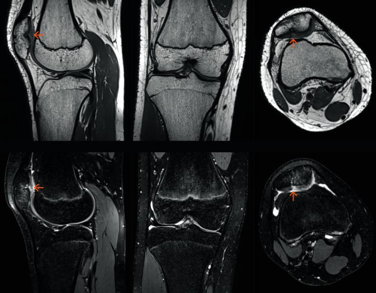 西门子GOKnee3D扫描可视化异常(橙色箭头)的膝盖一名14岁的男孩在骨科成像。# RSNA2017 # RSNA17