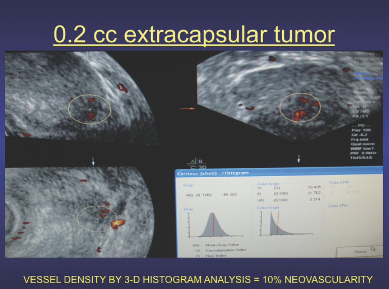 Histogram-volumetric研究显示囊外的10%的恶性肿瘤血管密度,可以作为参考测量来评估治疗效果在串行扫描