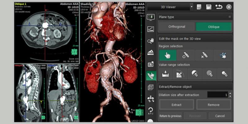 富士的Synapse 3D通过一贯精确和快速的图像处理为放射学、心脏病学和外科术前模拟提供了临床价值。