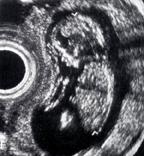 1978年:开始普遍使用超声波监测胎儿发育从第8周开始，以早期发现任何(遗传，染色体)畸形，并确定其性别。