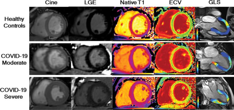 图2。LGE图像、原生T1图、细胞外体积图和全局纵向应变(GLS)显示中、重度COVID-19恢复期成人心肌异常。注意:此图片仅用于说明目的，与十大研究组无关。图片由放射学提供。