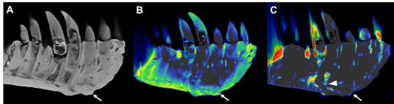 图2。左牙含牙部分的CT重建。（A) Reconstruction of the conventional CT images in lateral view showing well-preserved anatomical structures such as the replacement teeth. The arrow indicates the focal exophytic mass—the abnormal growth that sticks out from the surface of the tissue—on the ventral surface at the level of the 3rd to 5th tooth roots. (B) The DECT-based calcium material map shows a homogeneous mineral distribution, while (C) the fluorine material ma