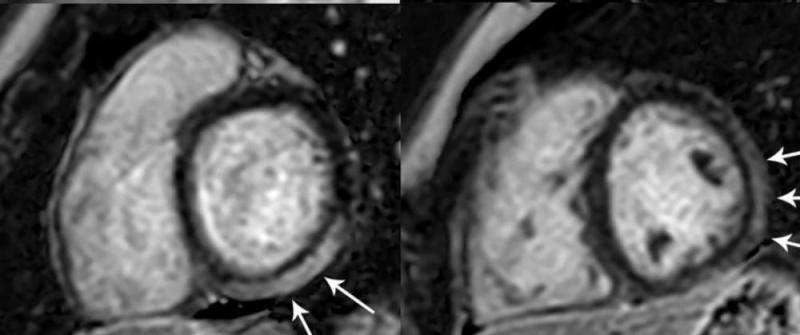 图3。MRI显示青春期女性左心室基底下段和下段及中心室水平左心室前段、下段和下段的明显LGE累及50%以上的心肌。注意:此图片仅用于说明目的，与十大研究组无关。影像由放射科提供:心胸影像学。