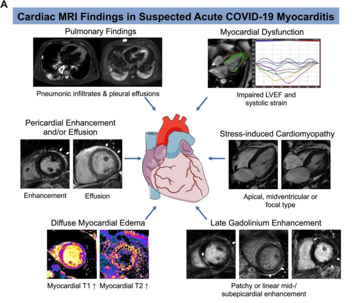 图4。疑似COVID-19急性心肌炎的心脏MRI表现示例。注意:此图片仅用于说明目的，与十大研究组无关。影像由放射科提供:心胸影像学。