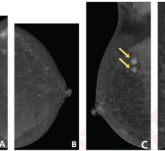 48岁女性，右乳2个肿块(箭头)行超声造影。CEM按以下顺序获得:(A)右乳房颅侧(CC)视图;(B)左乳CC视图;(C)右乳中侧斜位(MLO)切面;(D)左乳MLO视图。注射造影剂后，背景实质增强(BPE)程度随时间增加。(A)右乳CC视图显示轻度BPE，而随后获得的(B)左乳CC视图显示中度BPE。