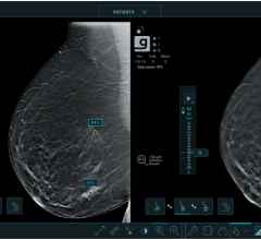 研究表明新的深度学习算法帮助放射科医生检测乳腺癌在早期阶段时使用的天才考试3 d乳房x光检查