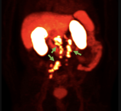18 f - rhpsma 7.3宠物图像显示前列腺癌前列腺以外的地区传播(照片由蓝色地球诊断)