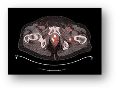 18f - rhpma -7.3 PET图像显示一名新诊断为前列腺癌的男性前列腺多区域摄取。图片由Blue Earth Diagnostics提供