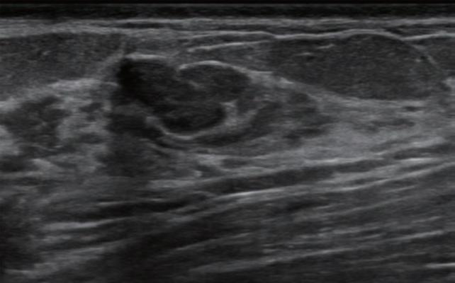 计算机辅助诊断应承担的改善乳房超声检查技术在多中心研究