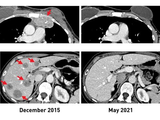 在接受TIL治疗之前，一名乳腺癌患者的胸壁(上，左)和肝脏(下，左)有转移性病变。在接受免疫治疗后，她的肿瘤完全缩小，最近的扫描(右)显示，五年多后她仍然没有癌症。国家癌症研究所