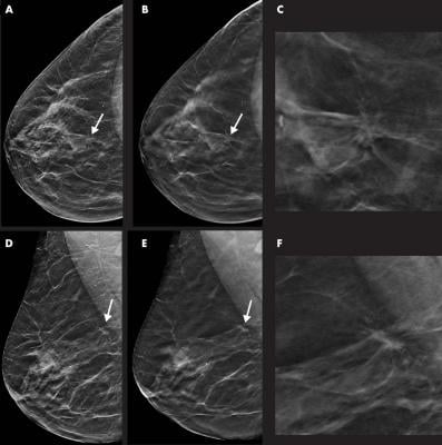 图像在一个55岁的女人,一个尖锐的本地化上中央象限(箭头a、B、D和E)的右乳房检测与数字乳房tomosynthesis(印度生物技术部)+人造乳房x光检查(SM)。乳腺密度被分类为类别与乳腺影像报告和数据系统C。2022世界杯篮球预选赛赛程质量是浸润性导管癌,I期,雌激素和孕激素受体阳性和人类表皮生长因子受体2阴性。身高,图像从SM视图。B、单