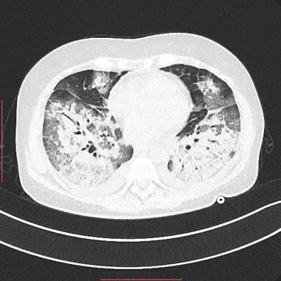 as肺CT横切面显示肺部重区冠状病毒肺炎
