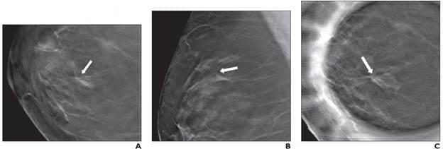 49岁女性接受乳房x光筛查，显示右乳房结构扭曲:(A)右颅颊部，(B)中外侧斜位，(C)点压缩断层合成图像显示右乳房12点位置(箭头)结构扭曲。超声检查未发现相关性。断层合成引导下的针活检发现放射状瘢痕，手术中未升级。