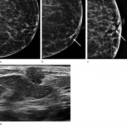 图像显示假阴性癌症症状在一个73岁的黑人妇女看到一个明显的异常后64天-筛查性乳房x光检查。(一)负筛选左数字乳房tomosynthesis(印度生物技术部)乳房x光检查。(b)诊断印度生物技术部的乳房x光片显示了新的明显质量(箭头所指)。(c) Spot-compression印度生物技术部乳房x光检查可以确认质量(箭头所指)。(d)超声(美国)的图像显示质量与角呈低利润率。随后US-guided活检显示雌激素受体和progeste