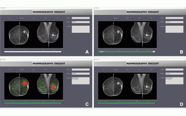 基于人工智能诊断系统的接口。图像显示界面外观当(A)加载一个新的乳房x光检查,执行图像评估,(B) (C)图像的显示结果评估通过的热图,和(D)图像的显示结果评价的热图关掉。