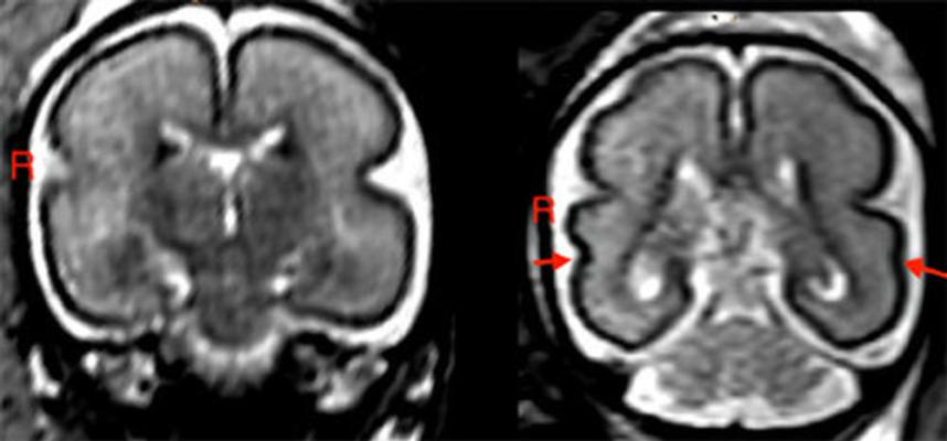 图1所示。左:胎儿大脑post-intrauterine胎儿酒精暴露在25至29孕周。注意frontoparietal光滑的皮层和颞叶。右:大脑匹配健康控制在25 - 28孕周胎儿。颞上沟已经形成双边(红色箭头),似乎更深右边比左边的半球。”typeof=