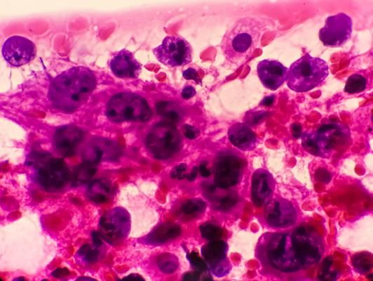 阐明3期临床试验的结果CYTALUX (pafolacianine)注射用于癌症IMI的肺已经出版