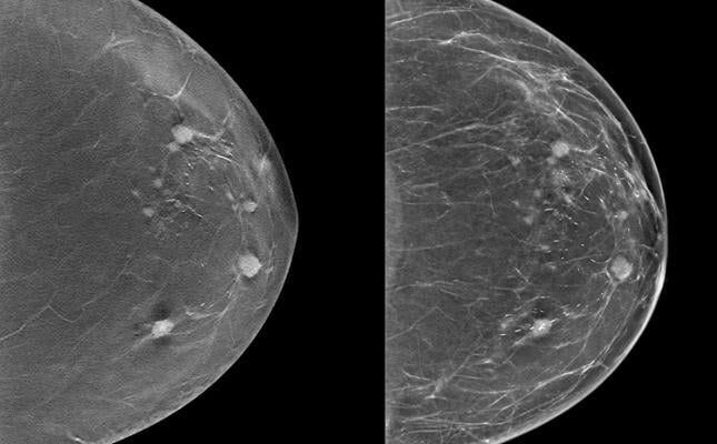 北美放射学会(RSNA)宣布启动RSNA筛查乳房x线摄影乳腺癌检测人工智能挑战赛。