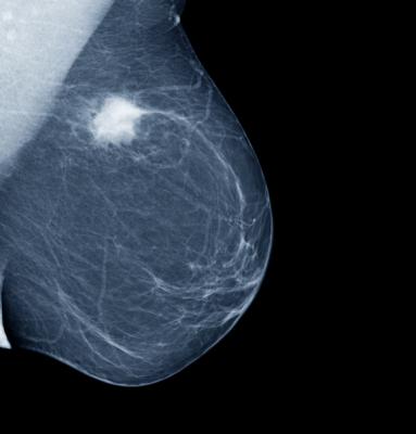 乳腺癌筛查可降低癌症死亡。AI工具有潜力提高筛选效率和有效的。