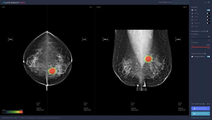 Lunit算法显示最佳的性能比其他商业化的智能算法,最终减少放射科医生的工作负载分类乳房x光检查检查