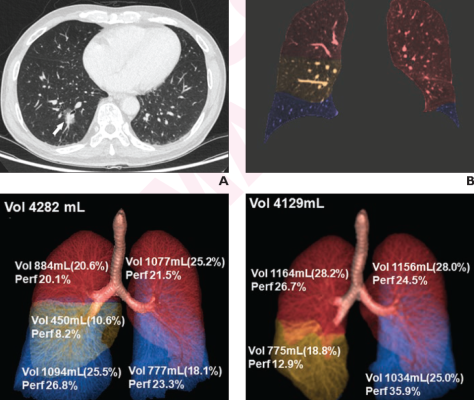 76岁的男性病人接受了肺癌的右下叶切除术。(一)轴向图像从preop DECT胸部考试显示2.3厘米part-solid结节在右低叶(箭头所指)。结节证实代表肺腺癌,根据手术标本的病理评估。(B)在70 kev单色图像颜色叠加显示了五个肺叶的分割。红色代表上层叶;黄色显示右侧中部叶;和蓝色表示下叶。三维体绘制的图像(C)