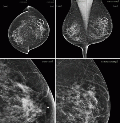 乳房x光成像与浸润性导管癌51岁的女人。上面的面板显示身高和中间外侧的斜的观点。较低的面板显示包含病变的左胸区域的特写。假阴性病例的案例是一个包含在数据集。因此,最初的筛选评估BI-RADS 2,意义可见发现的人被认为是良性的。1年之后,病人提出了另一个筛选检查。这一次,与associ焦不对称