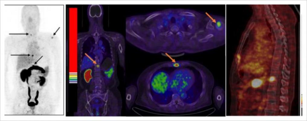 PET / CT、原发性和转移性前列腺癌,核医学杂志》上的研究,JNM