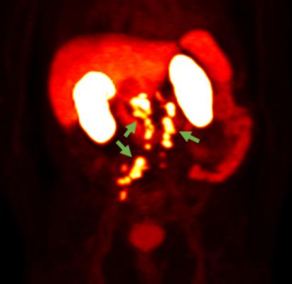 口头报告包括额外的结果从蓝色地球的第三阶段关注研究评估临床因素的影响检出率的18 f - rhpsma 7.3 PET成像在前列腺癌疑似复发后基于PSA升高之前治疗