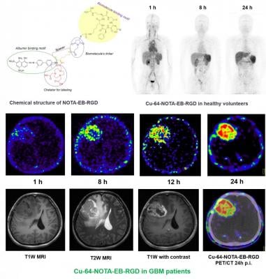在注射后1、8、24小时注射64Cu-NOTA-EB-RGD的健康志愿者的代表性最大强度投影PET图像。注射64Cu-NOTA-EB-RGD后不同时间点胶质母细胞瘤患者轴向MRI和PET切片图片由张晶晶等人提供，北京协和医院，中国/陈晓元等人，分子成像和纳米医学实验室，NIBIB/NIH，美国贝塞斯达