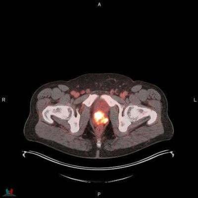 POSLUMA (flotufolastat F 18) PET / CT图像显示前列腺吸收,符合原发性前列腺癌诊断照片的蓝色地球