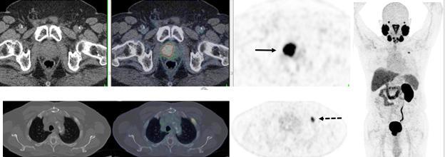PSMA PET/CT可准确检测67岁男性复发性前列腺癌。18F-DCFPyL-PSMA PET/CT显示前列腺广泛、强烈的psma局部复发(下排;实箭头)与已知的前列腺肿瘤复发相一致。右图:PET显示前列腺广泛、强烈的pma -avid局部复发(上排;实心箭头)和左肋骨2处的孤立骨转移灶(下排;虚线箭头)。图片由Ur Metser等人提供。