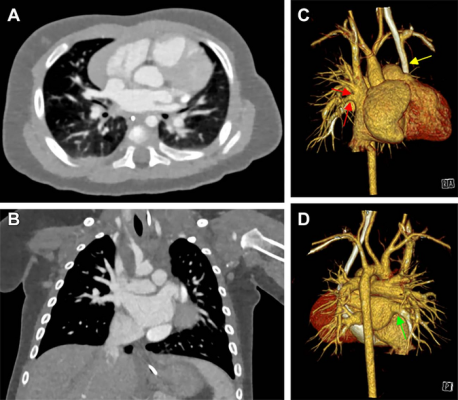 心脏光子计数CT (PCCT) 174天的男性婴儿复杂先天性心脏缺陷。