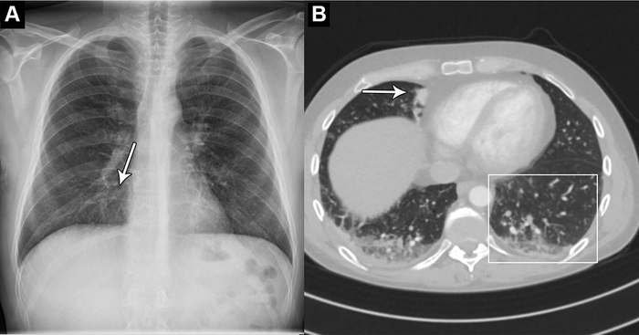 44岁男性，胸痛和呼吸困难。(A)胸片显示非常细微的结节性不透明，主要在下叶，代表肺炎和右心边界的离散剪影征(箭头)。人工智能系统将这张胸部x光片解读为正常。在临床放射学报告中也被解释为正常。(B) CT扫描显示下叶空域混浊，树芽形态模糊(方框)，实变区域(箭头)。肺安吉人