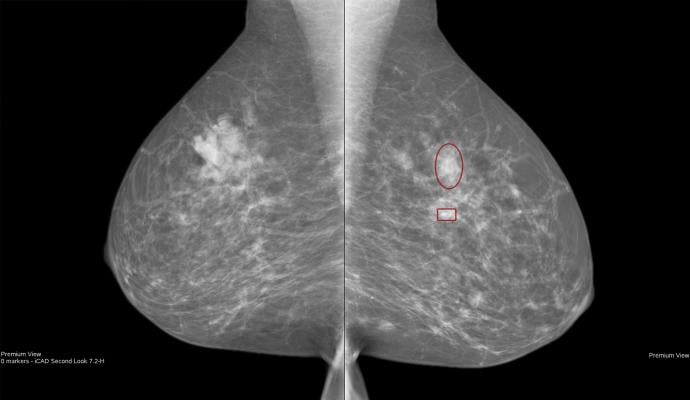 超重的妇女可能需要更频繁的乳房x光片