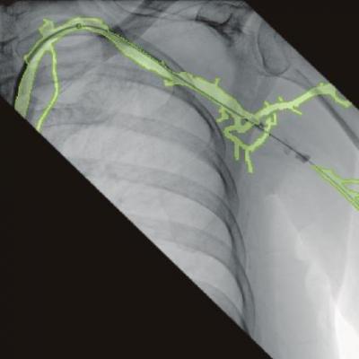 一个例子的三维血管Ziehm移动c臂系统技术路线图。
