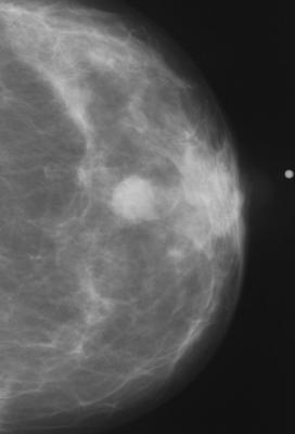 图8。不正常的乳房x光检查。