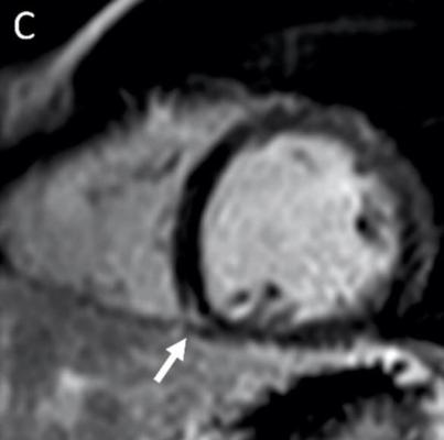 图1所示。19岁男性右心室附件(箭头)MRI显示晚期钆强化(LGE)。注意:此图片仅用于说明目的，与十大研究组无关。图片由放射学提供。