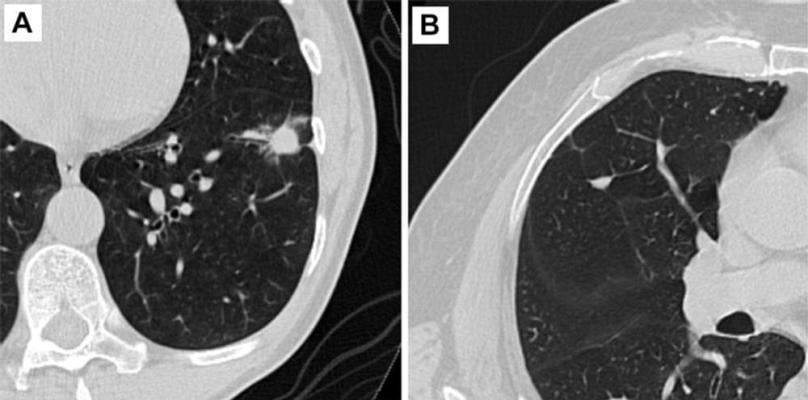 图2。肺结节的CT轴位图像。(A)恶性结节。(B)良性结节。