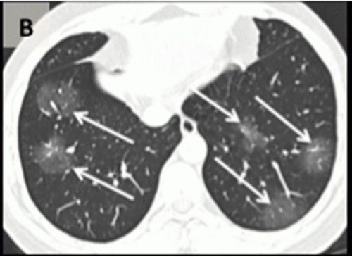 轴向CT图像获得没有静脉对比一个36年岁的男性(面板)显示两国地面上叶玻璃的透明与圆形形态(箭头)。#冠状病毒# nCoV2019 # 2019 ncov # COVID19