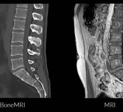 这个间隙BoneMRI现在可以对大多数相关诊断核磁共振扫描仪在美国,放射科医生,外科医生和病人