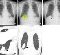 援助从一个人工智能(AI)算法具有较高的诊断准确性提高放射科医师性能检测肺癌胸部x射线和增加人类接受人工智能建议,根据一项研究发表在放射学杂志的北美放射学会(RSNA)。
